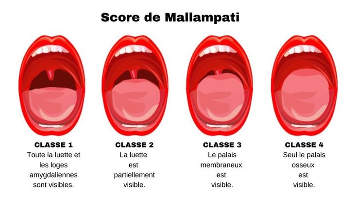 Impact de la langue sur le ronflement - Tongue Lab Academy